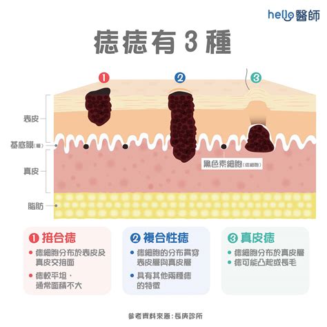 臉上的痣長毛|痣變大、痣多或長毛會變皮膚癌？認識痣的形成與原因